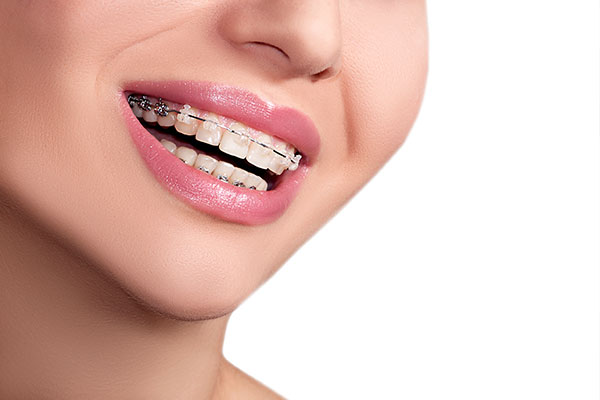 What You Need To Know About Lingual Braces