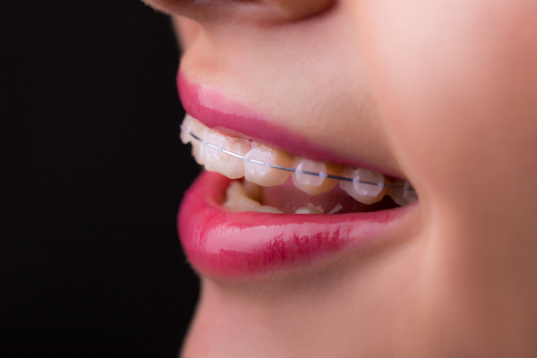 How Long Does Treatment With Clear Braces Normally Take?