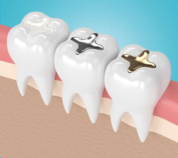 Los Alamitos Composite Fillings