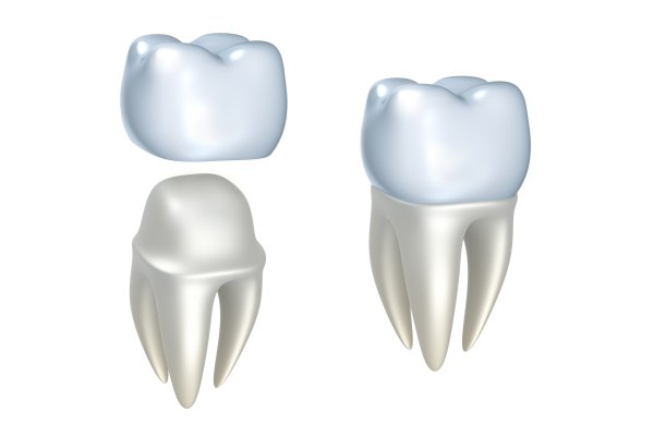 dental implants Los Alamitos, CA