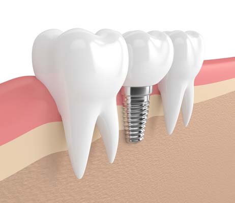 Replacing A Missing Tooth With A Single Dental Implant