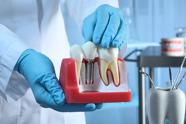 FAQs About Tooth Implants