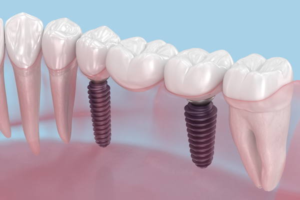 What To Do If A Dental Implant Crown Breaks
