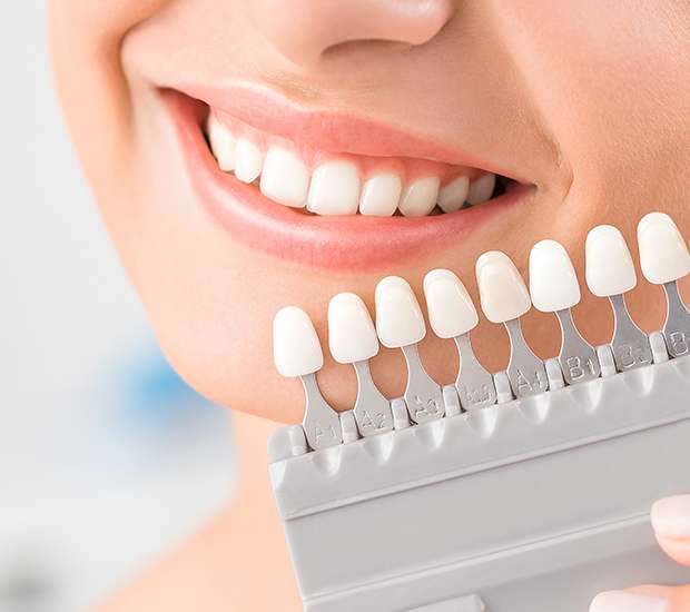 Los Alamitos Dental Veneers and Dental Laminates
