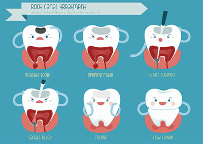 Why You Should Visit Our Los Alamitos Office For A Root Canal