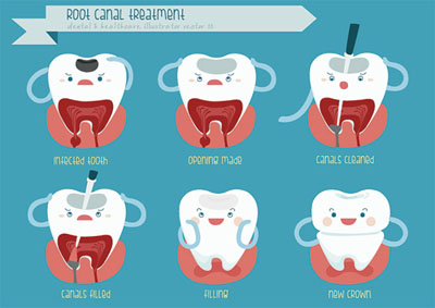 Root Canal