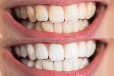 Why So Many People Need Teeth Whitening And How It Works