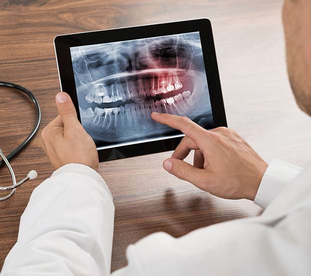 Los Alamitos Types of Dental Root Fractures